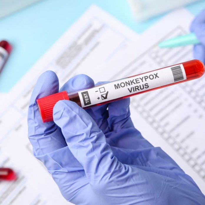 texto8_variola_sindhosp 93.5% dos hospitais paulistas enfrentam dificuldades no diagnóstico da Monkeypox